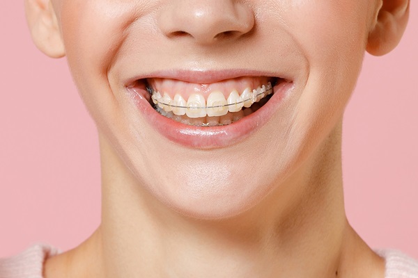 What Are The Benefits Of Getting Braces?